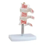 Cutaway Osteoporosis