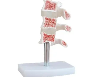 Cutaway Osteoporosis