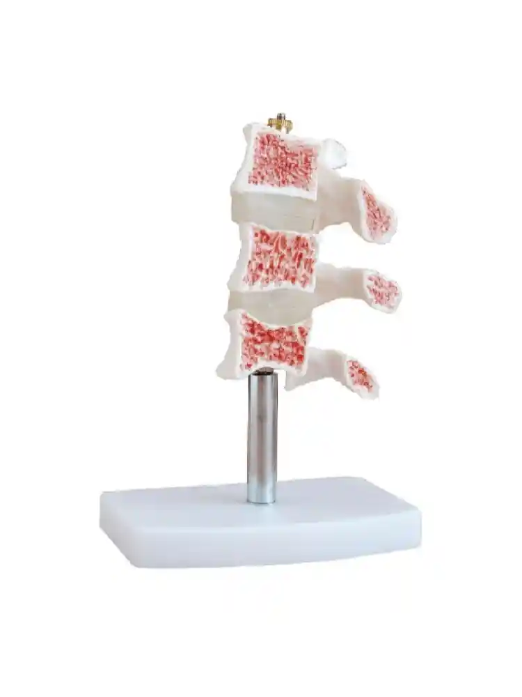Cutaway Osteoporosis