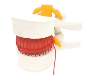Functioning Prolapsed Lumbar Vertebrae Model