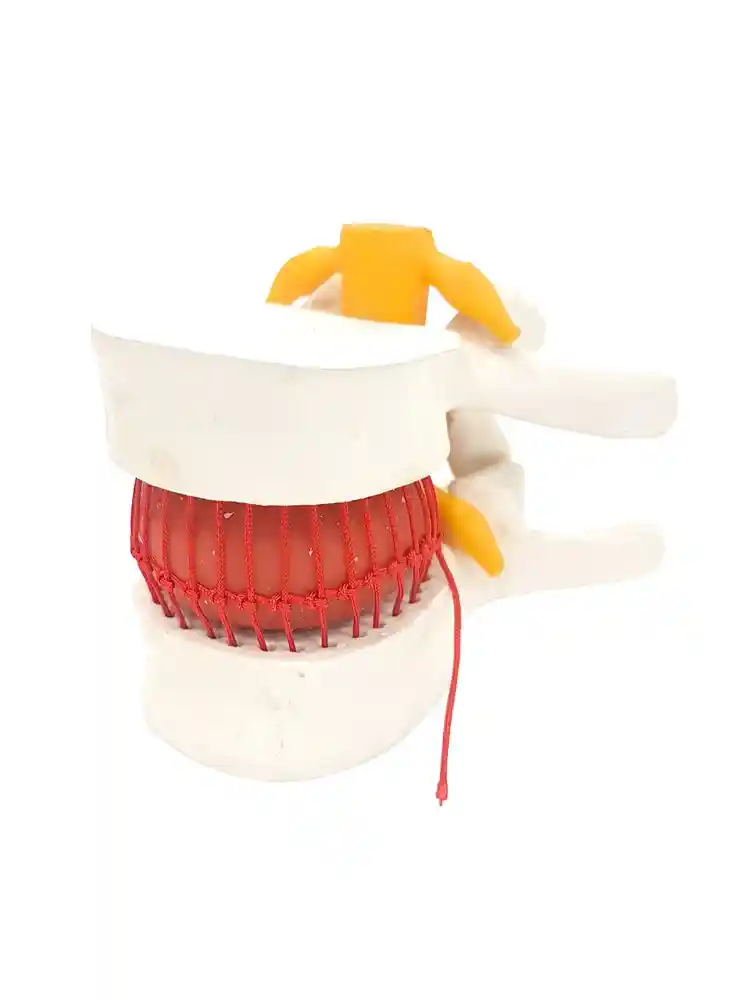 Functioning Prolapsed Lumbar Vertebrae Model