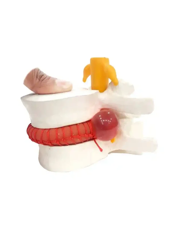 Functioning Prolapsed Lumbar Vertebrae Model - Image 2