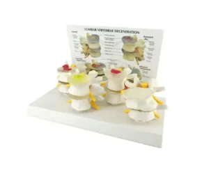 Lumbar Vertebrae Degeneration Model