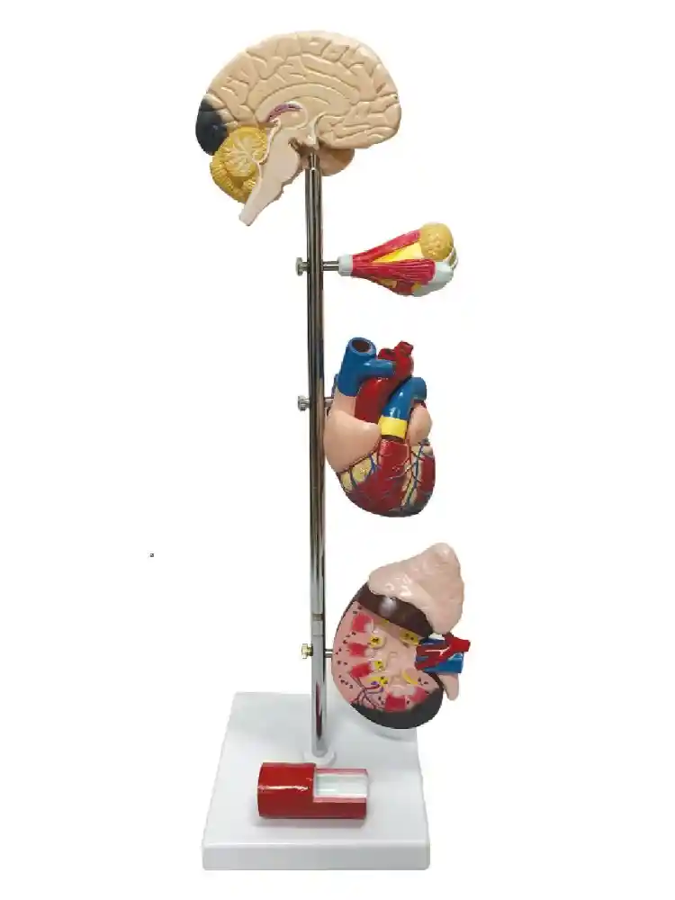 Hypertension Model