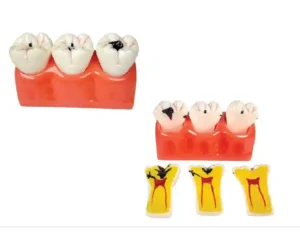 Dental Caries Model