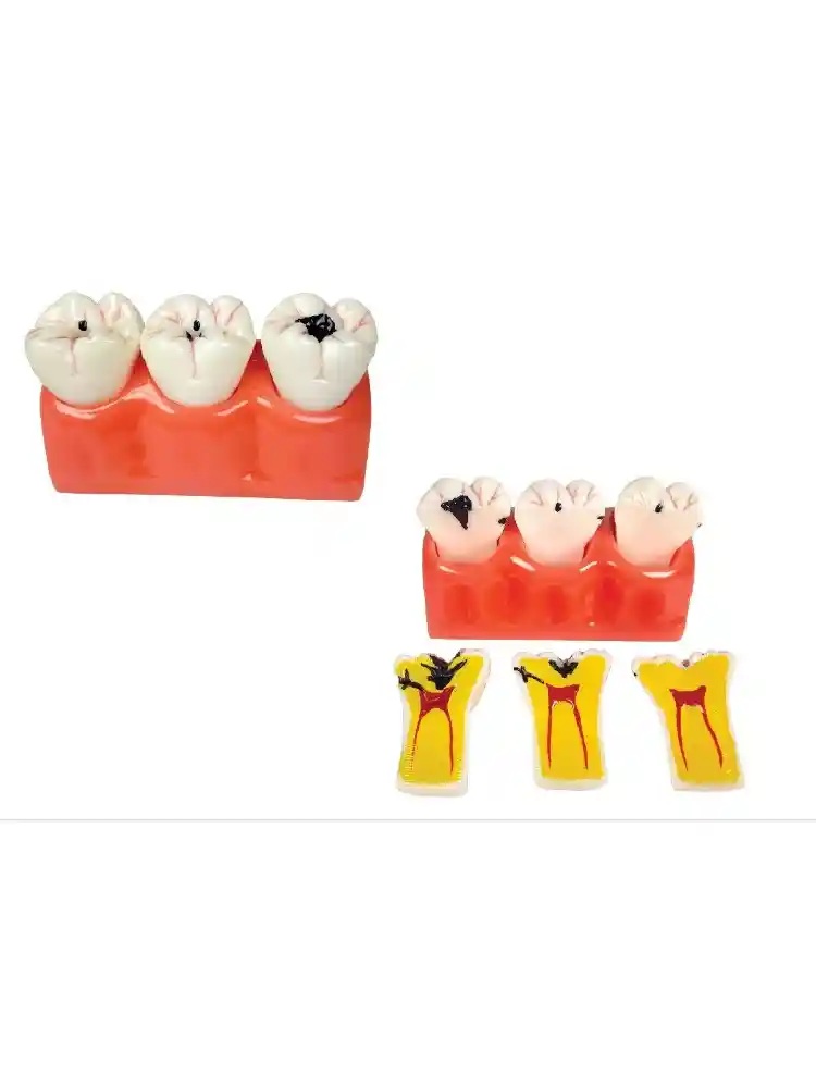 Dental Caries Model