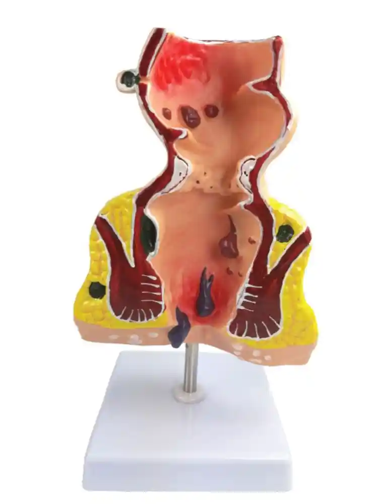 Rectum Pathologies Model
