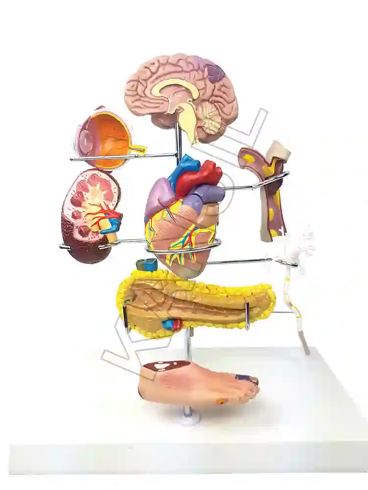 Diabetes Mellitus Complications Model